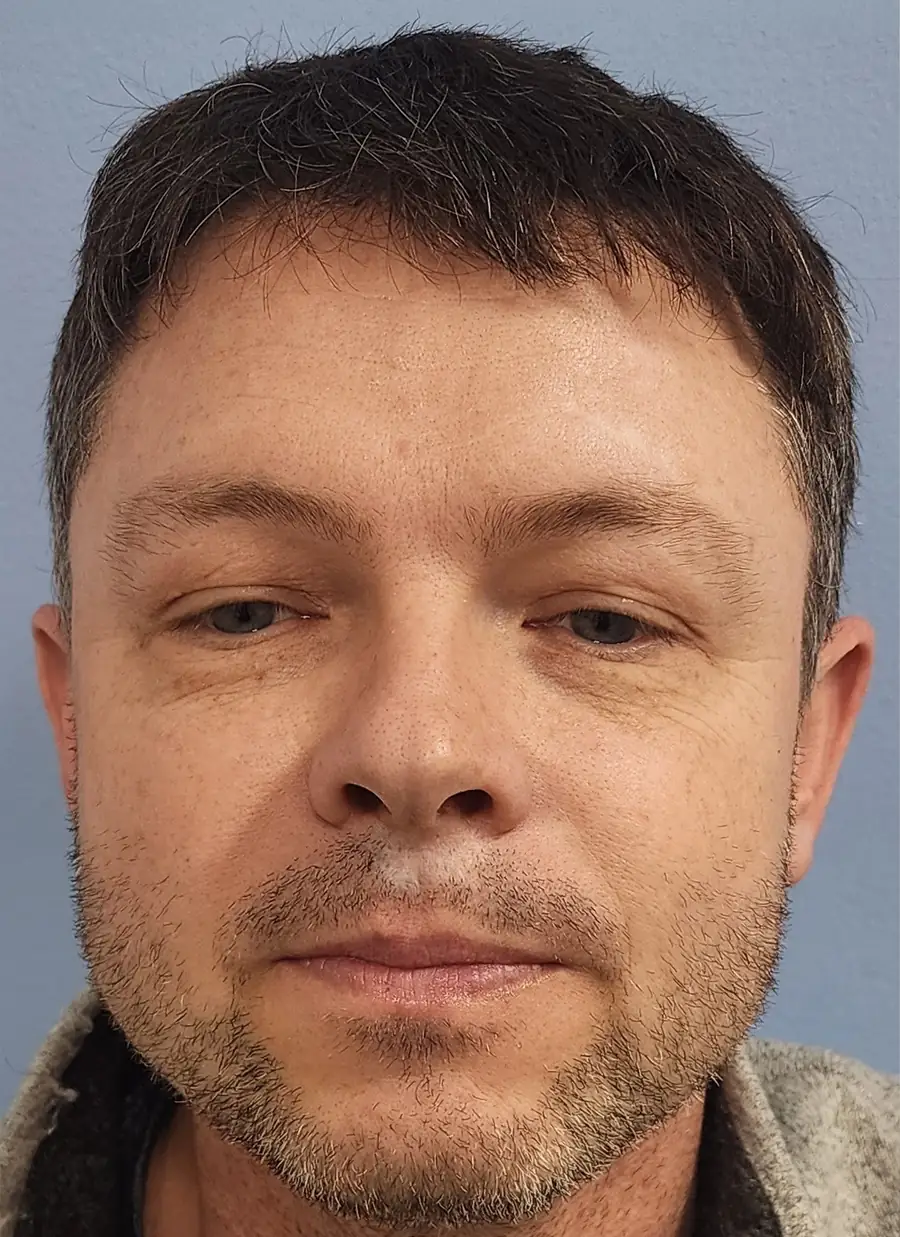 Before hair transplant — 275 grafts · 44 y/o man