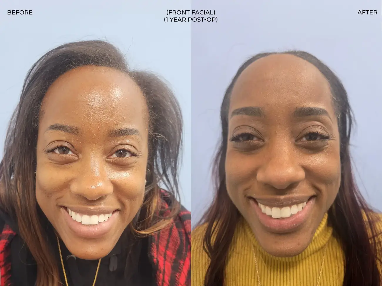 Front facial view before and after FUE (NeoGraft), 2,011 grafts, 40 year old woman