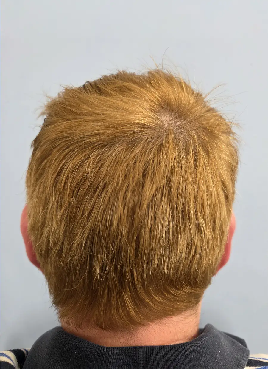 After hair transplant — 3,300 grafts · 57 y/o man