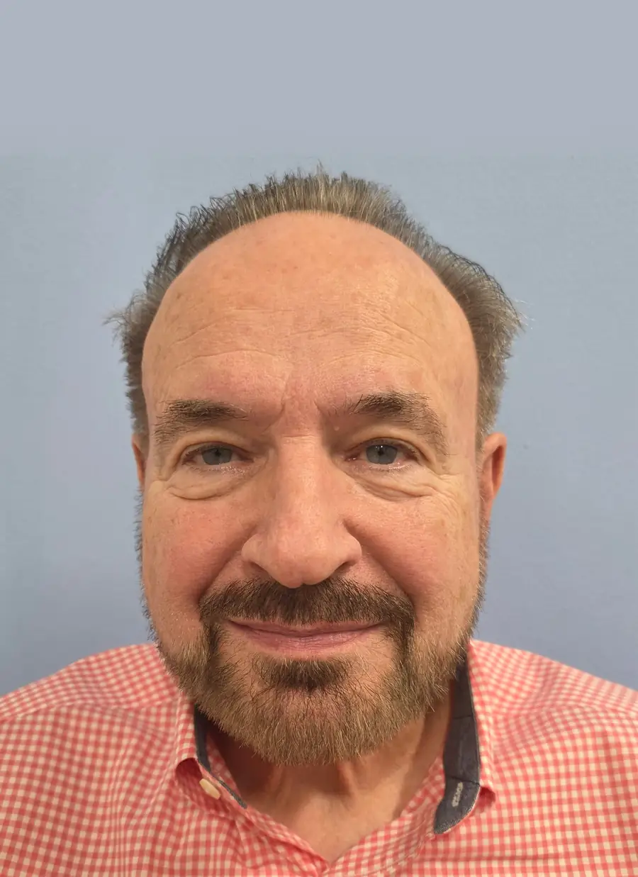 After hair transplant — 2,752 grafts · 74 y/o man