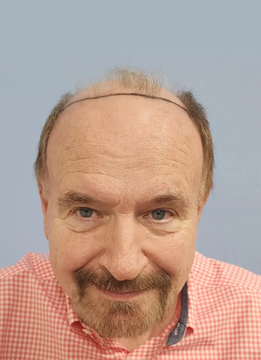 Before hair transplant — 2,752 grafts · 74 y/o man