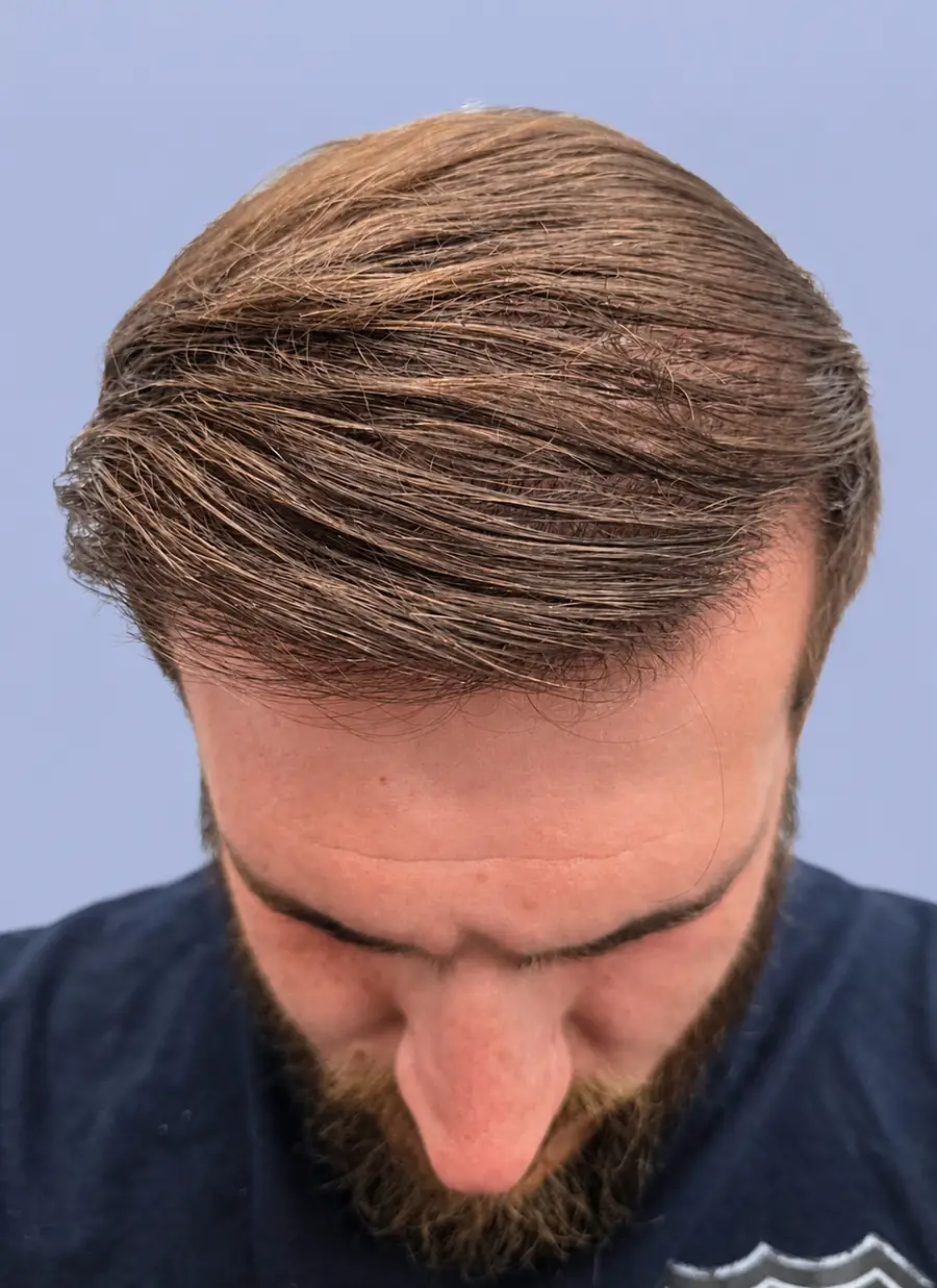 After FUT (strip), two procedures, 3,019 grafts