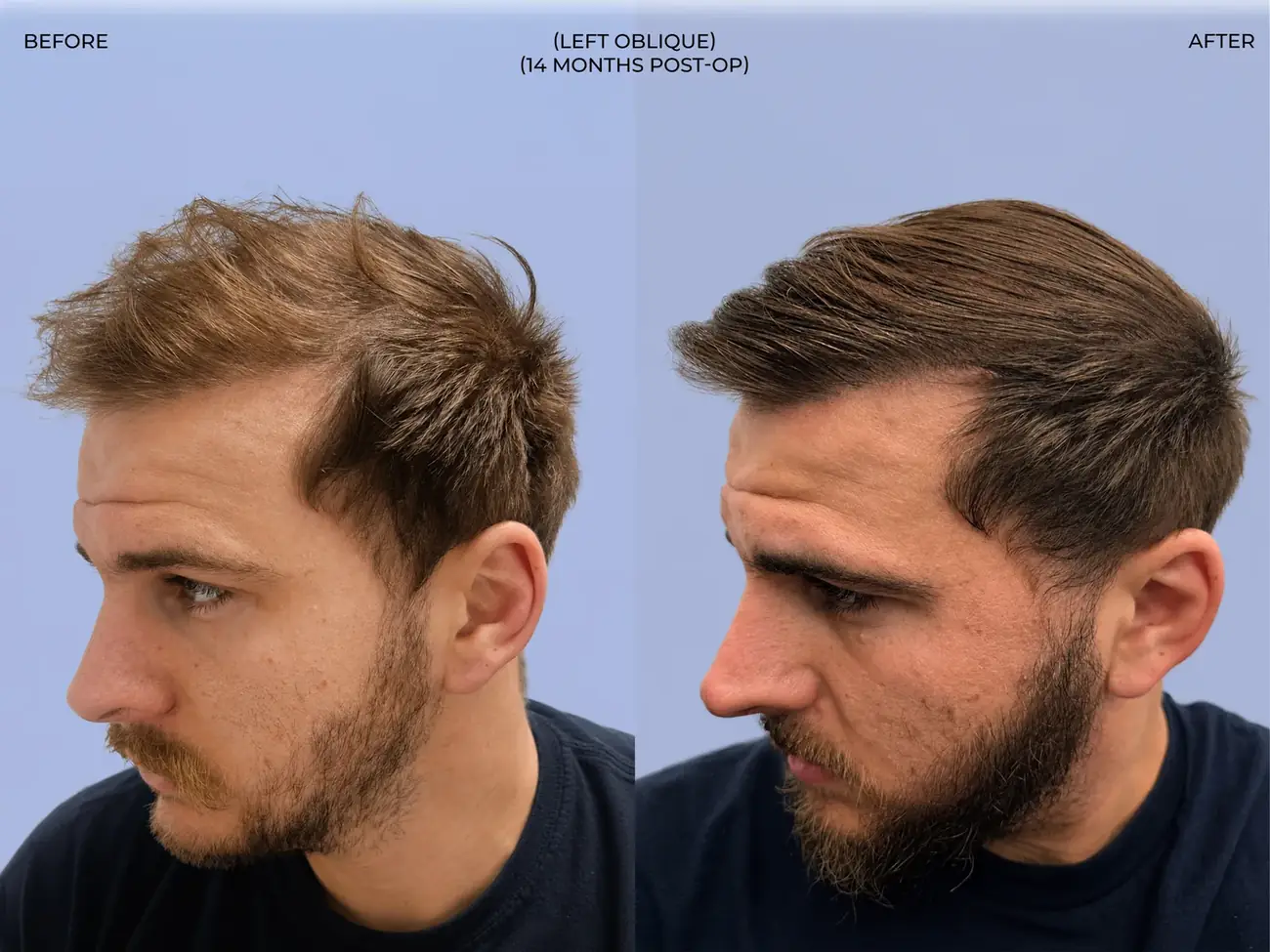 Left oblique view before and after FUT (strip), two procedures, 3,019 grafts, 31 year old man
