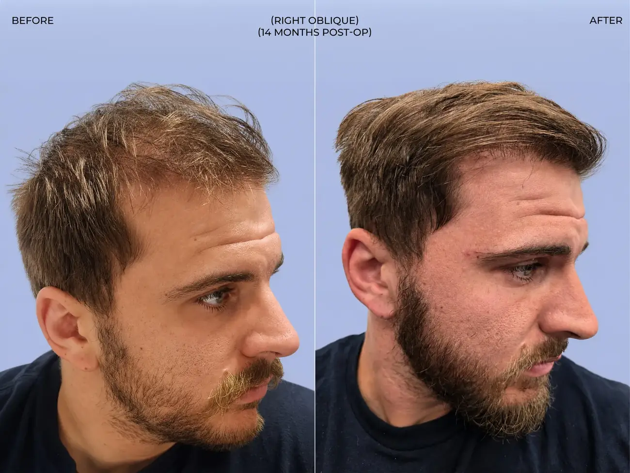 Right oblique view before and after FUT (strip), two procedures, 3,019 grafts, 31 year old man