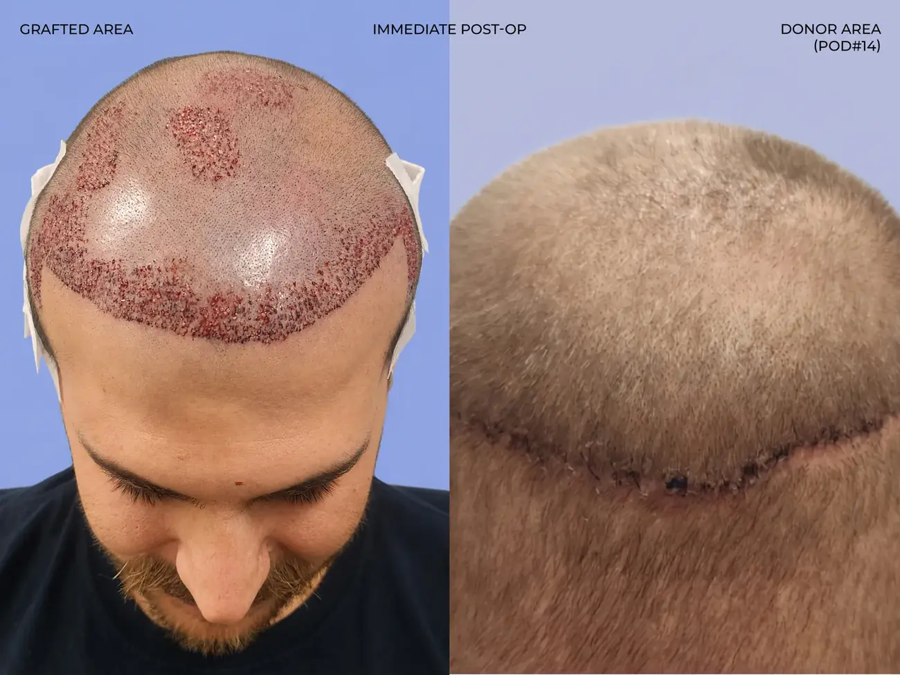 Hairline close-up view before and after FUT (strip), two procedures, 3,019 grafts, 31 year old man